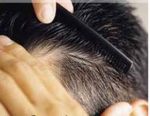 عوامل تأثیرگذار بر ریزش مو