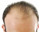 چگونه از ریزش موی ارثی جلوگیری کنیم