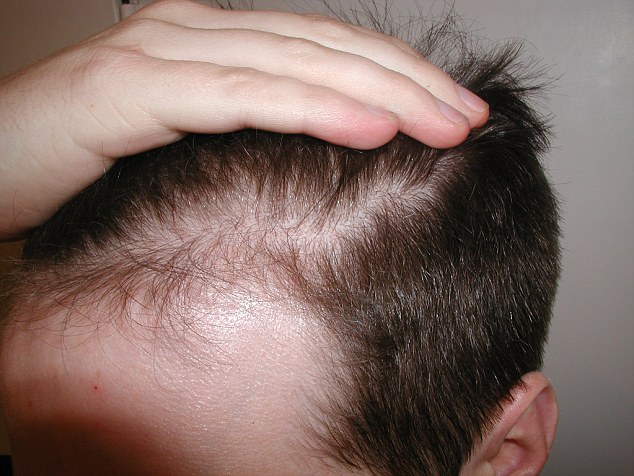 ریزش موی ناگهانی در مردان