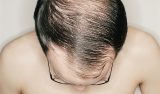 9 عامل موثر در ریزش موی مردان