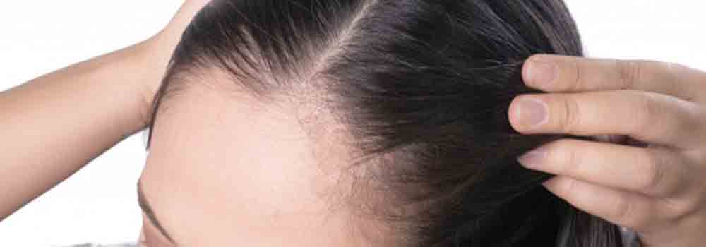 الگوی ریزش مو در زنان